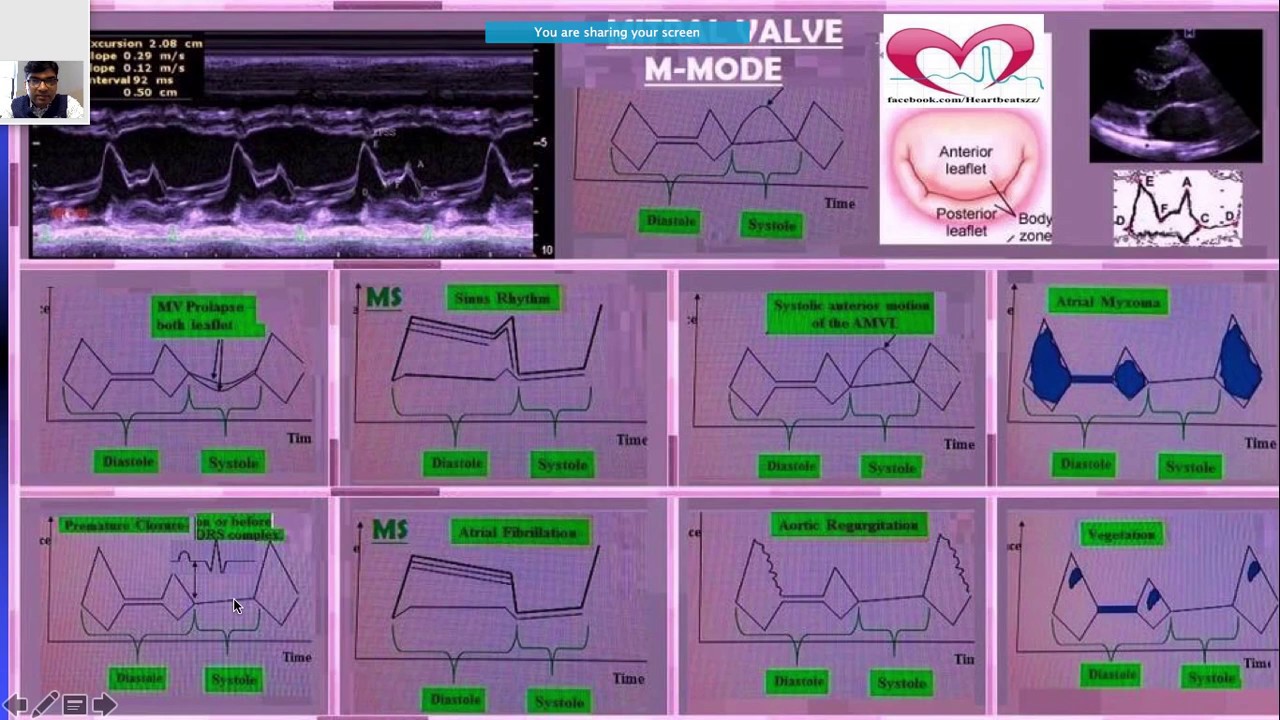 #Echocardiography basic 2 - #valvular #ischemic  #IHD #RHD heart disease