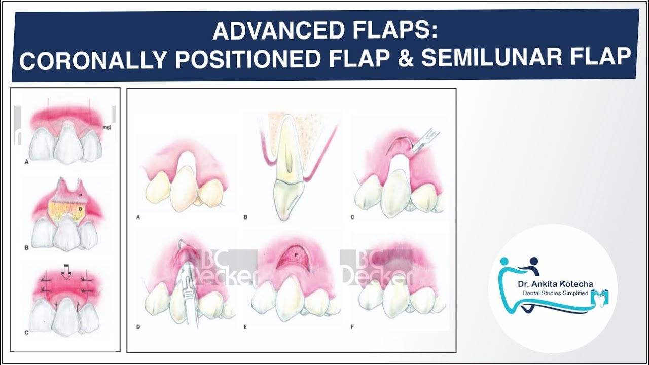 ADVANCED (PEDICLE) FLAPS| CORONALLY POSITIONED FLAP| SEMILUNAR FLAP| ROOT COVERAGE| DR. ANKITA