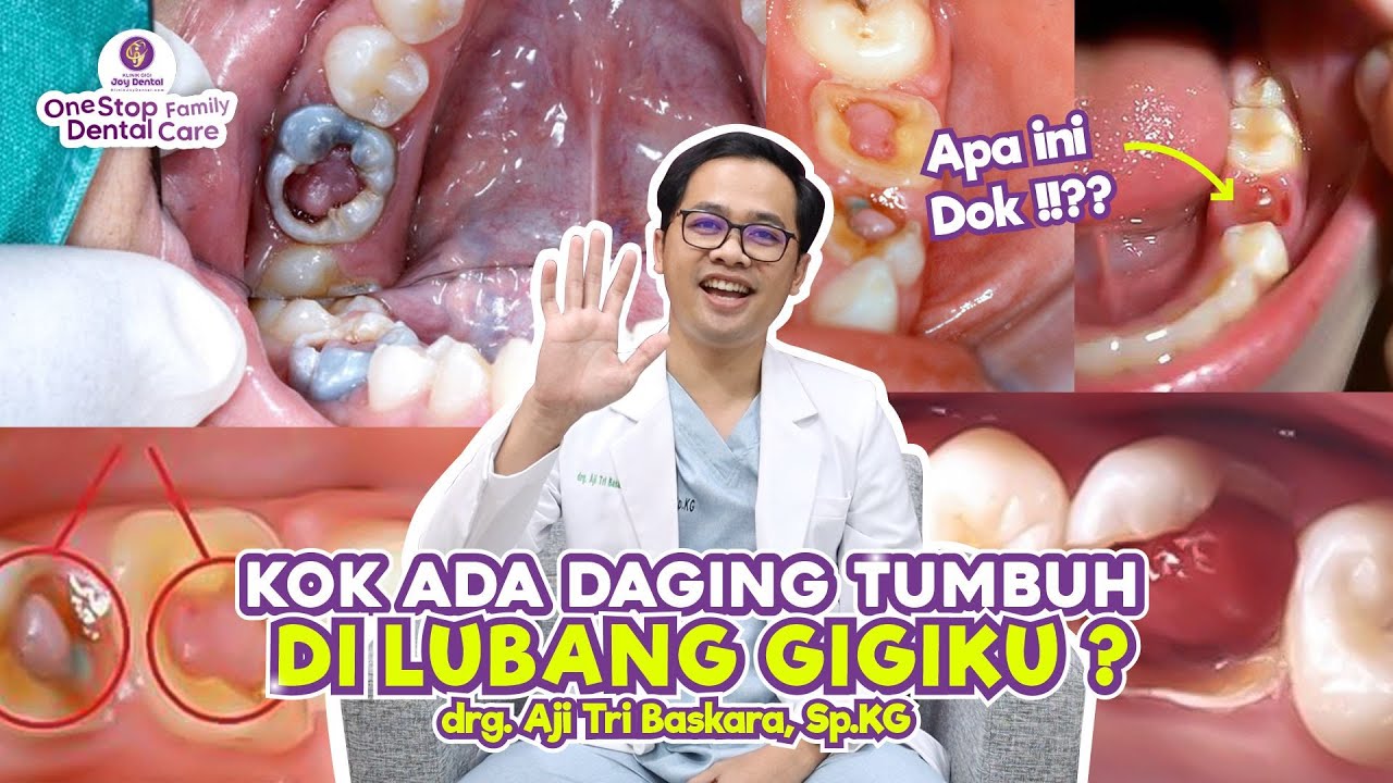 PULPA POLIP ! DAGING TUMBUH DI TENGAH GIGI BERLUBANG