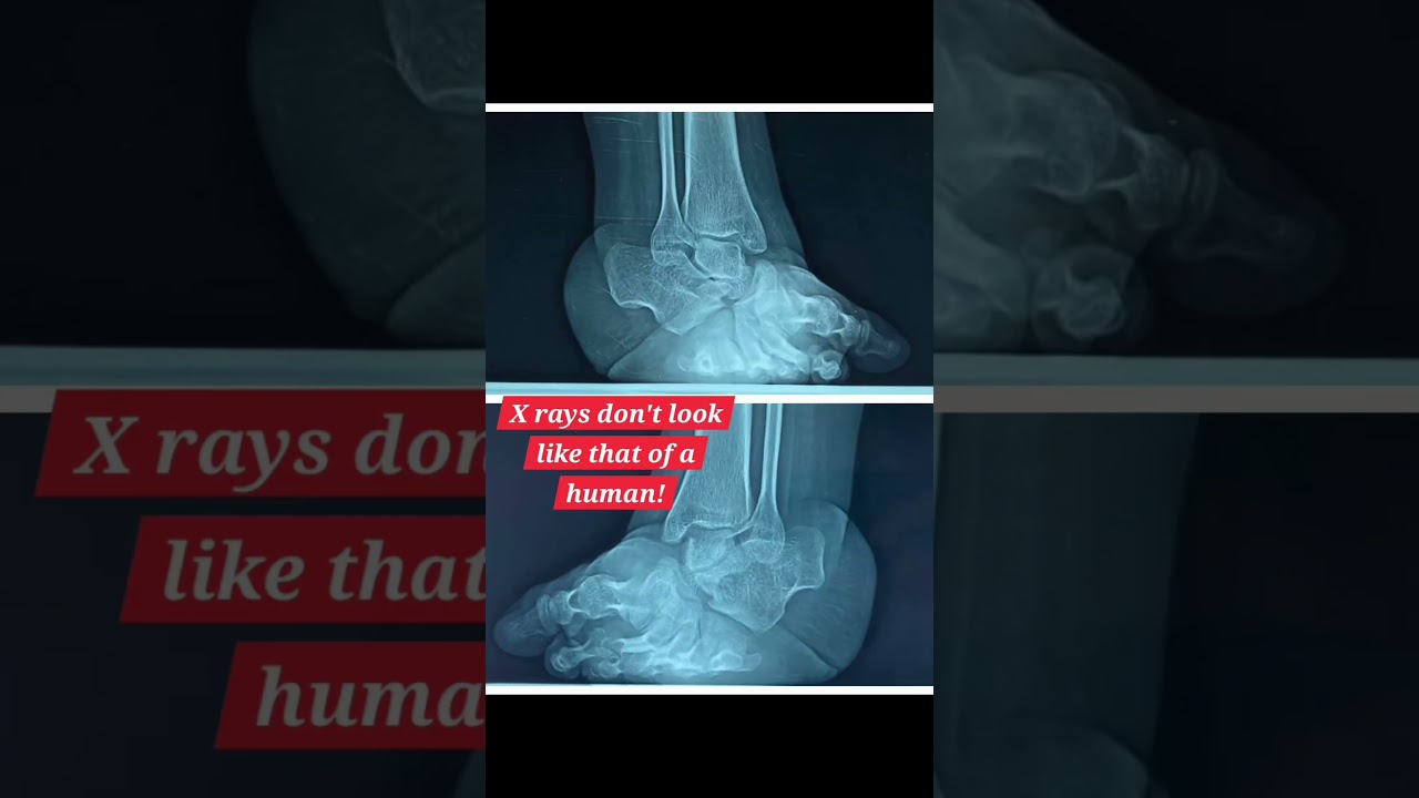 Neglected CLUBFOOT Surgery #ctev #doctor #footandanklesurgeon #orthopaedics #bones #deformity