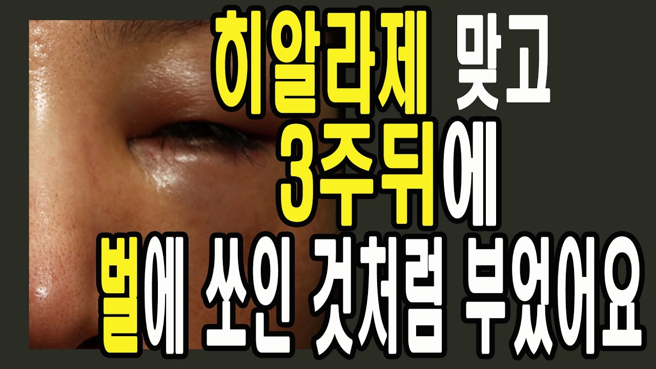 [CN SUB]필러 녹일려고 히알라제 맞고 3주뒤 너무 붓고 통증이 심해요.