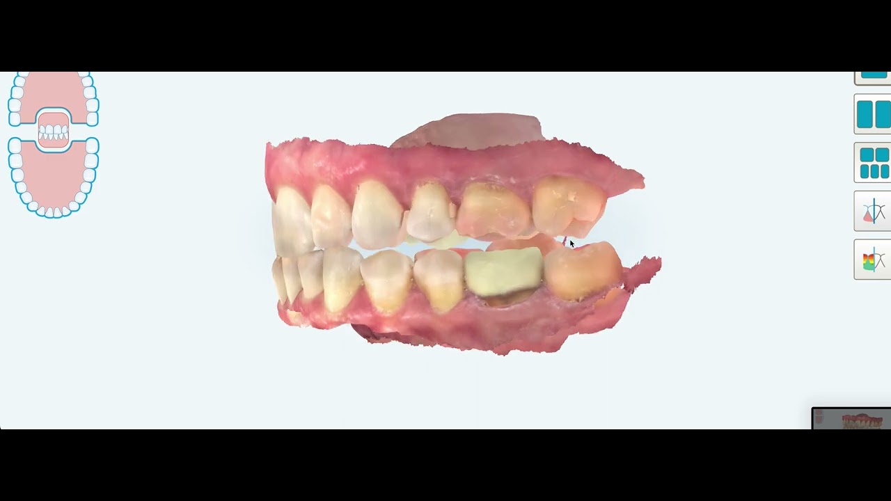 Mandibular Advancement Side Effect