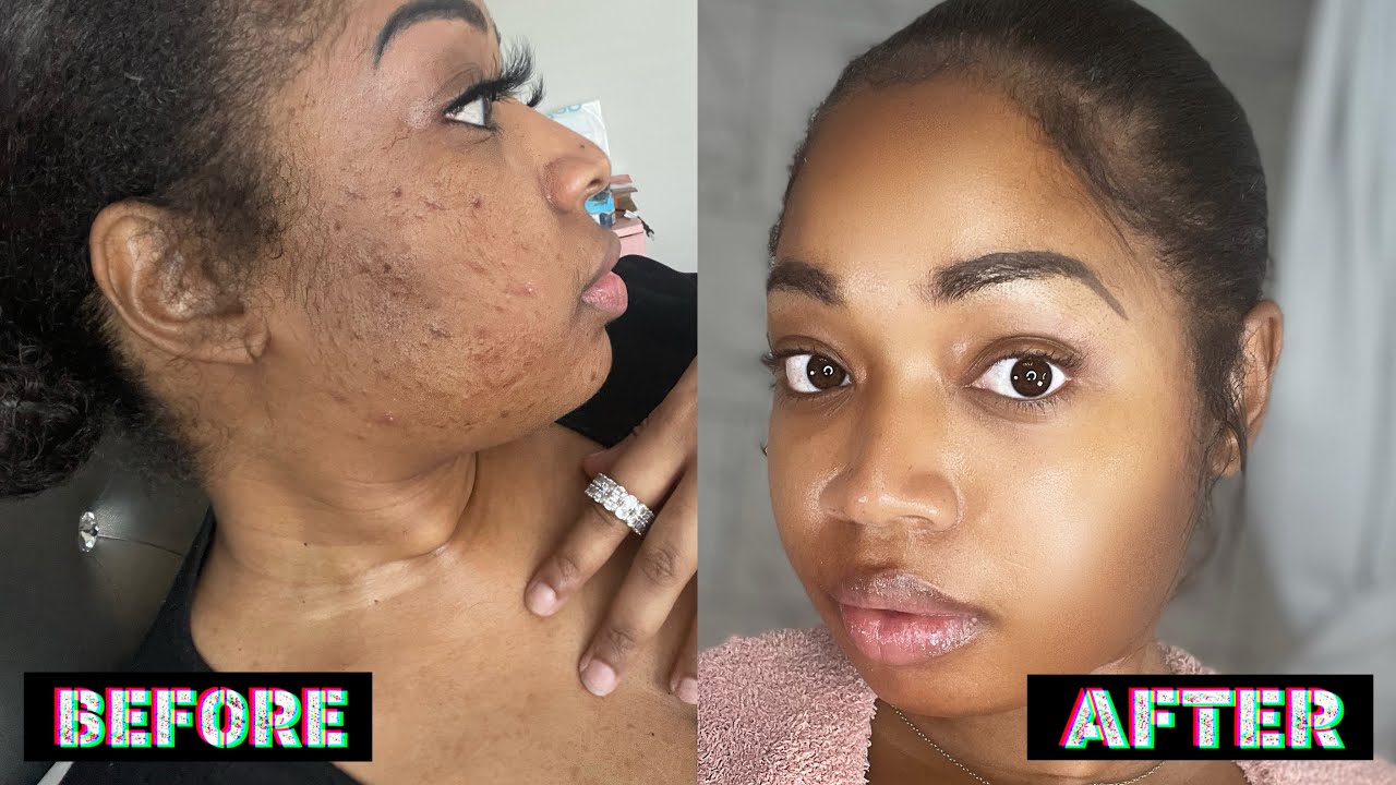 HOW I CLEARED MY ACNE IN ONE WEEK USING FENTY SKIN || 2021 SKIN CARE ROUTINE