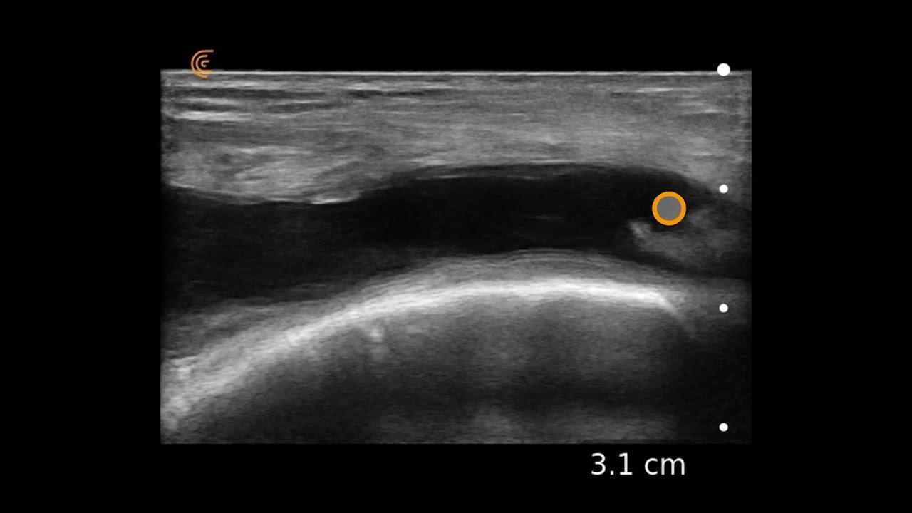 Knee Effusion: Ultrasound Image Interpretation