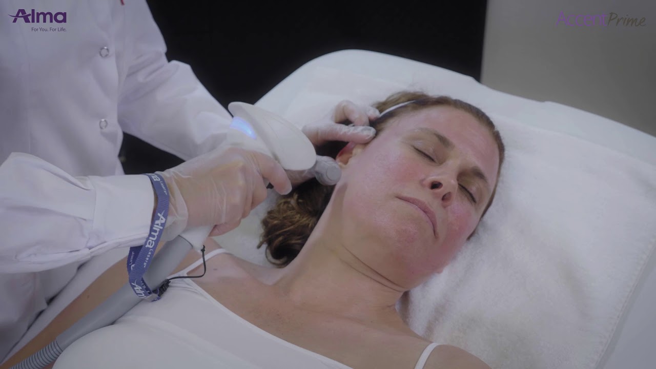 Accent Prime RF pixel applicator Skin Resurfacing&Scar treatment 0