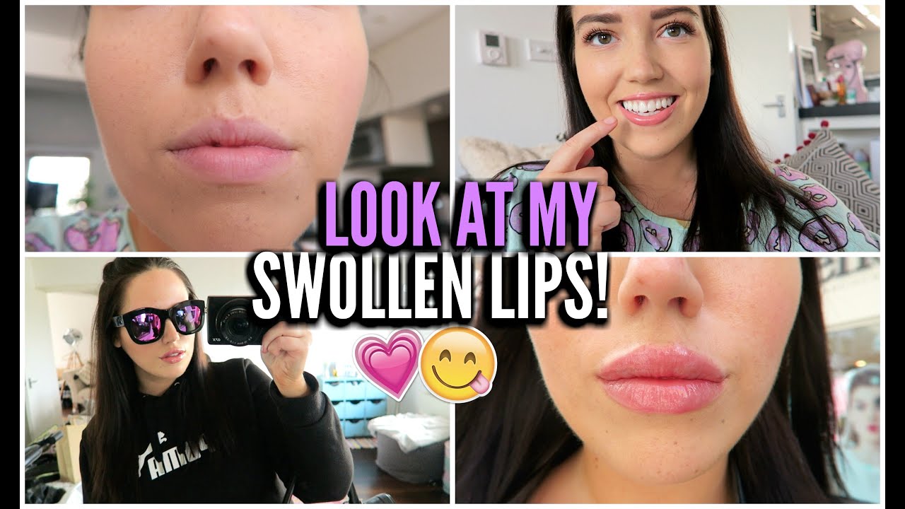 I GOT LIP FILLERS!