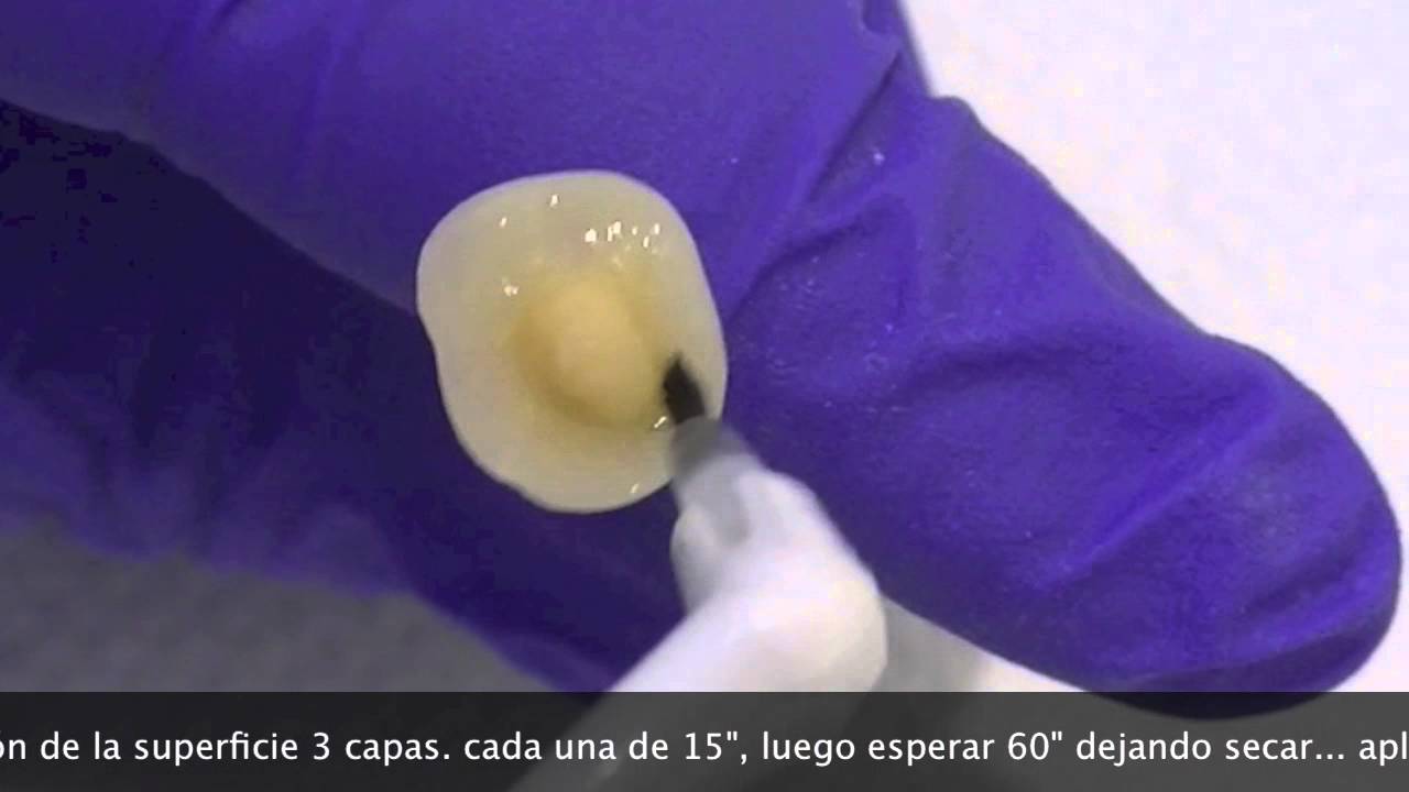 Como cementar Incrustación dental Overlay composite o cerómero tratamiento de incrustación Parte I