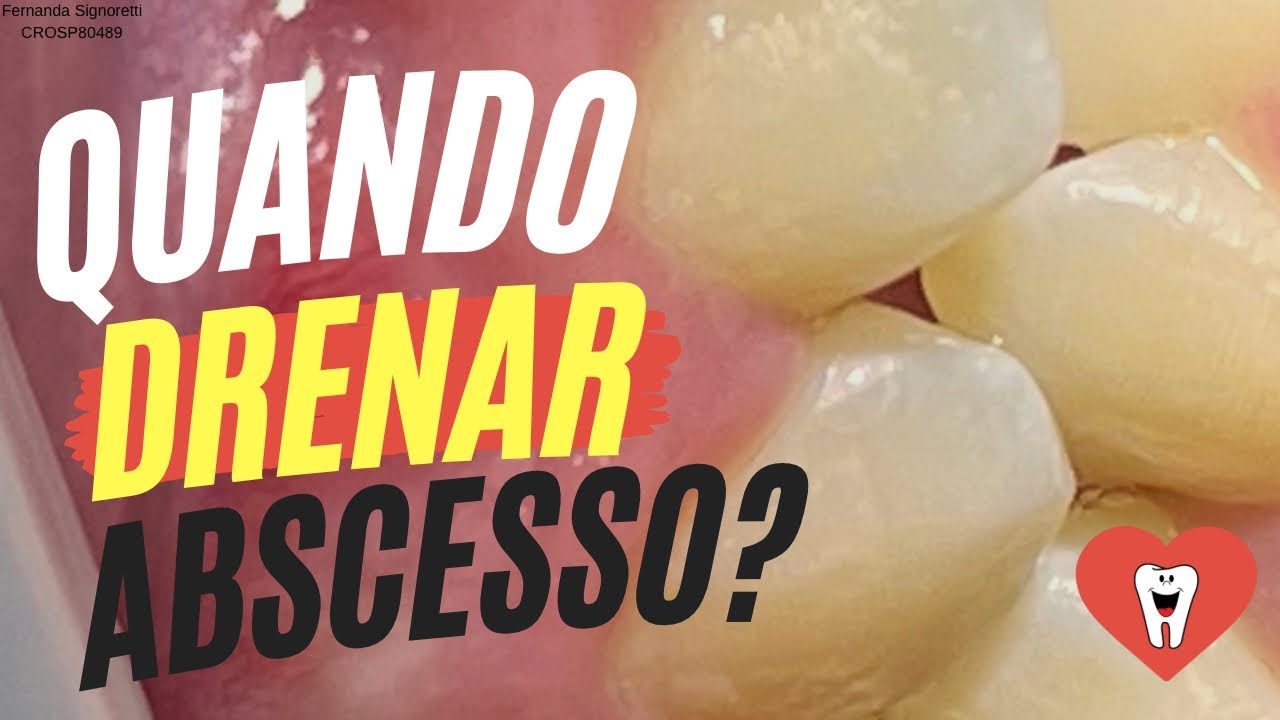 QUANDO SE DEVE DRENAR ABSCESSO COM ORIGEM NO CANAL? - Endolovers