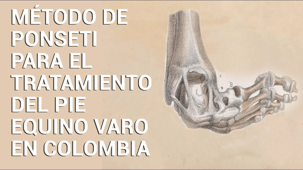 Tratamiento Método Ponseti Colombia - Rotary International