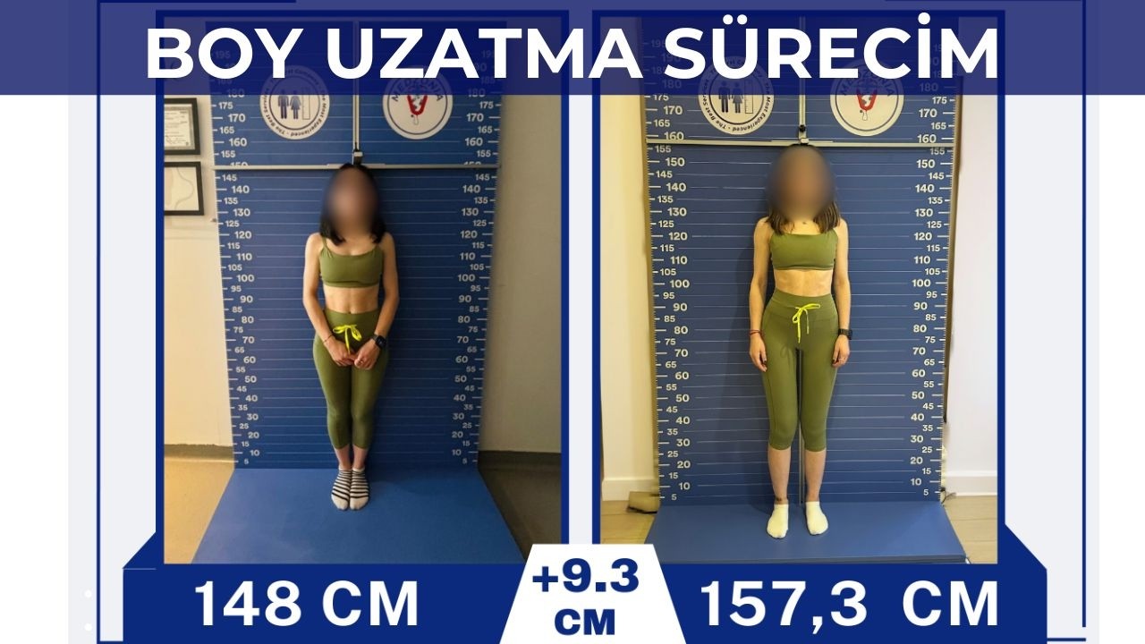 Boy Uzatma Ameliyatı Sonrası: Güvenle Yeni Bir Başlangıç (9,3 cm)