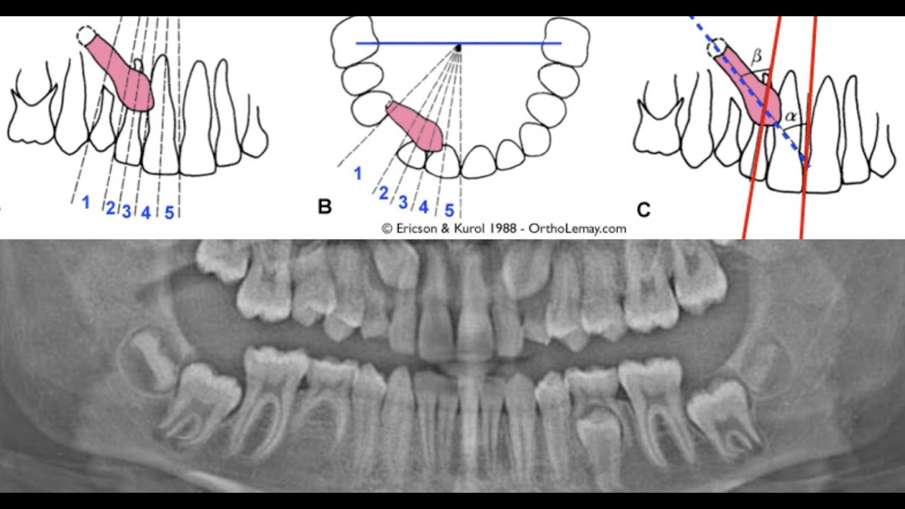 Impacted Canines: A Brother-and-Sister Case Study