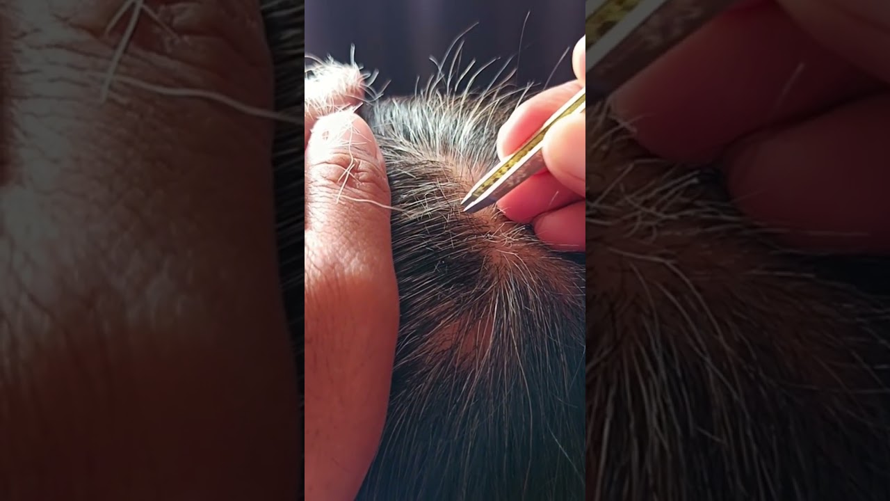 Most satisfying white hair removal#53#musicbackground #satisfying 