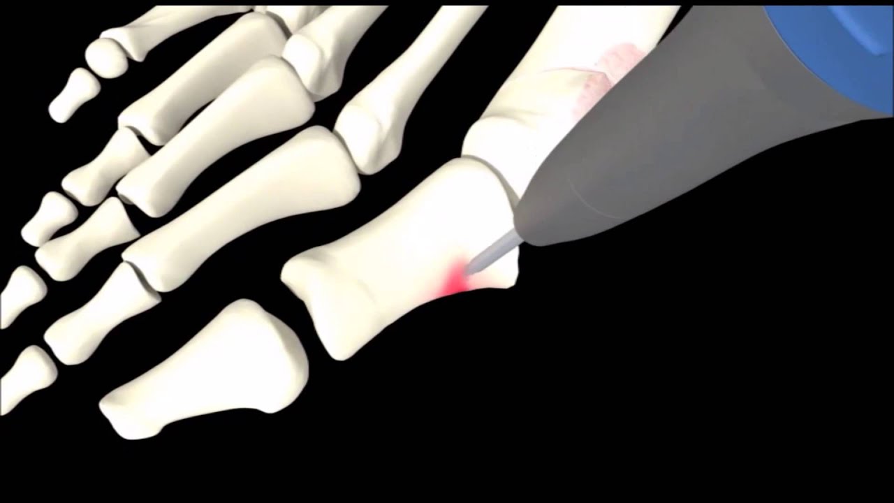Operatie Hallux Valgus (scheefstand grote teen) via minimale invasieve correctie