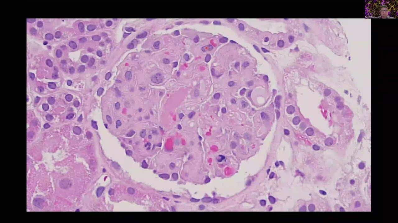 Kidney Biopsy Conference