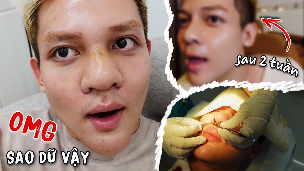 TRẦM CẢM KHI VỪA THÁO BĂNG !!! Vlog cả quá trình dưỡng thương của mình (ft Phúc Tít)