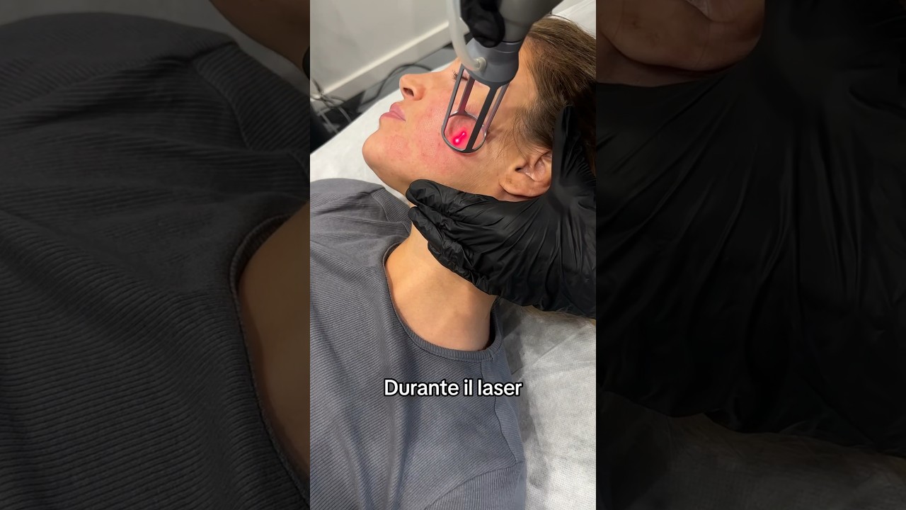 Risultati laser Co2 per macchie e cicatrici da acne