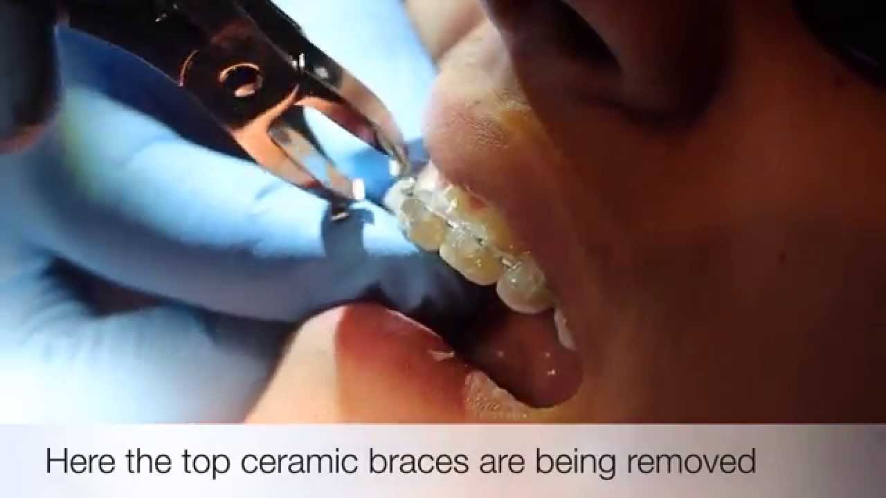 Getting Braces Off!! - Faces Orthodontics