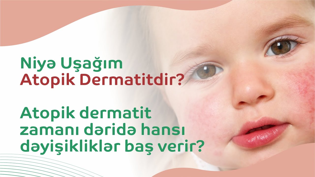 Uşaqları Atopik dermatit xəstəliyindən necə qorumaq lazımdır? #İnteqrativTibb #atopikdermatit