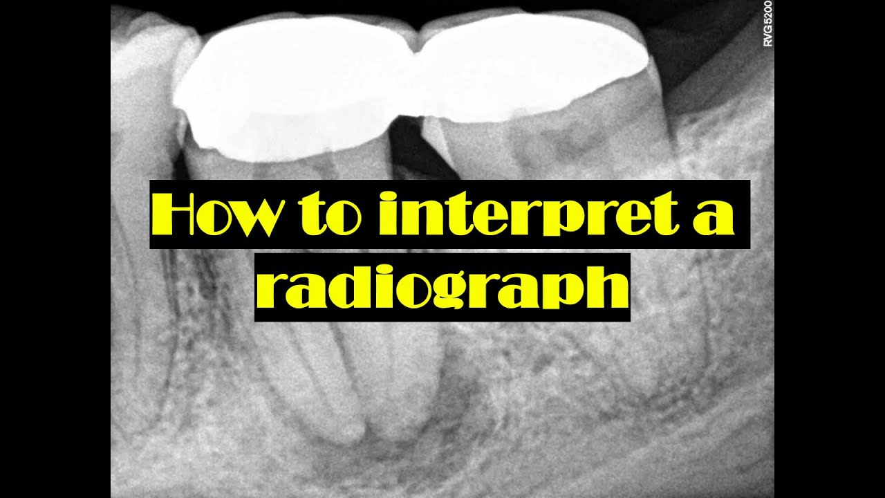 How to interpret radiograph in Endodontic & Restorative perspective