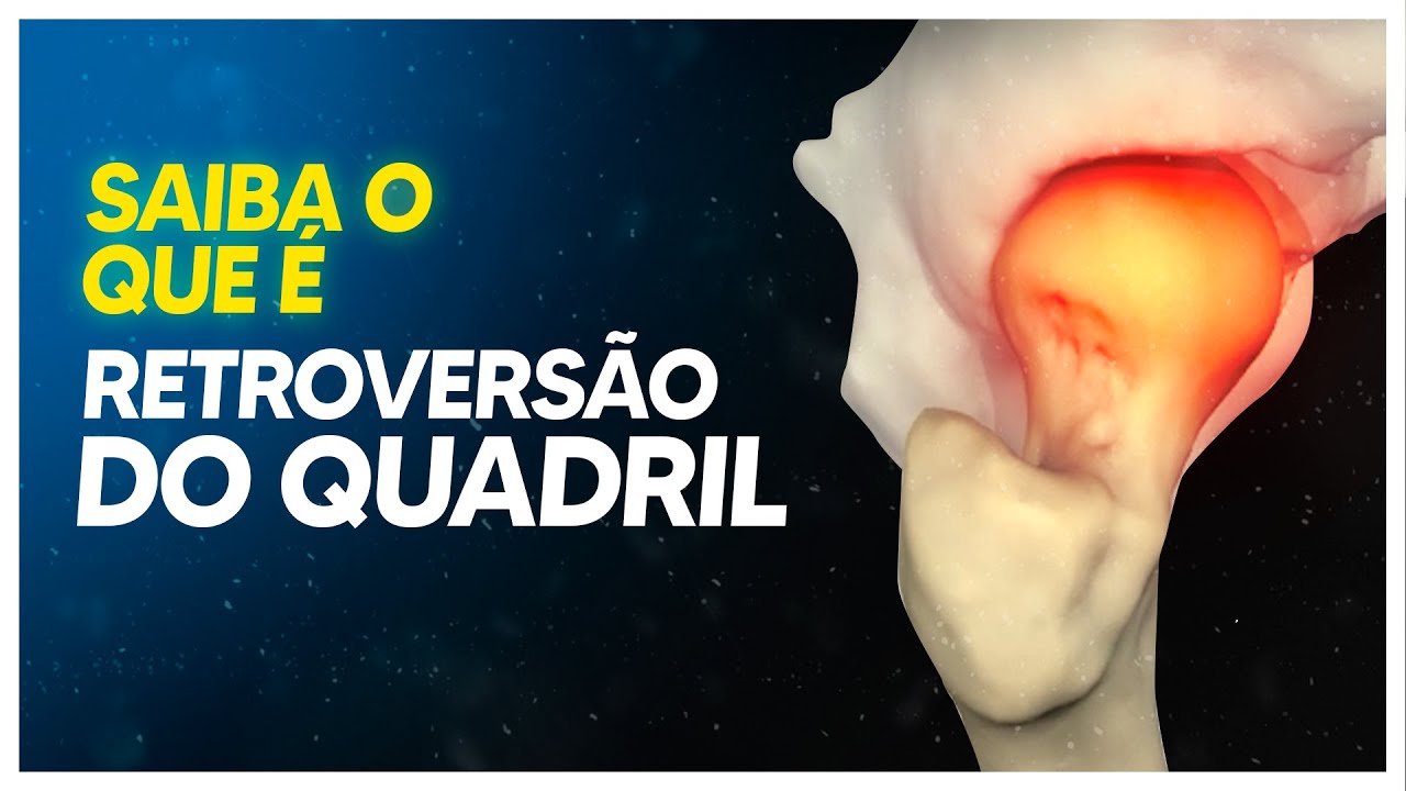O QUE É E COMO ACONTECE A RETROVERSÃO FEMORAL NO QUADRIL?