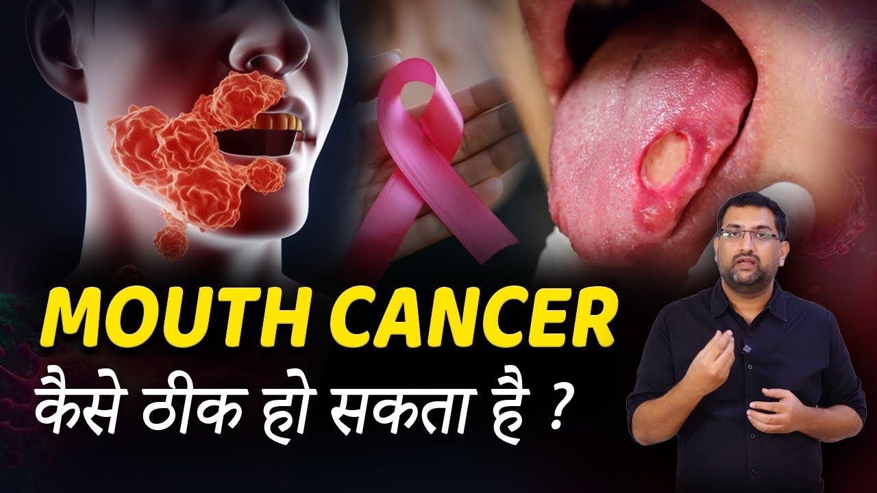 Mouth CANCER TREATMENT in hindi | मुँह का कैंसर | Cancer Treatment | Dr.Avinash Chaitanya | Kaizen