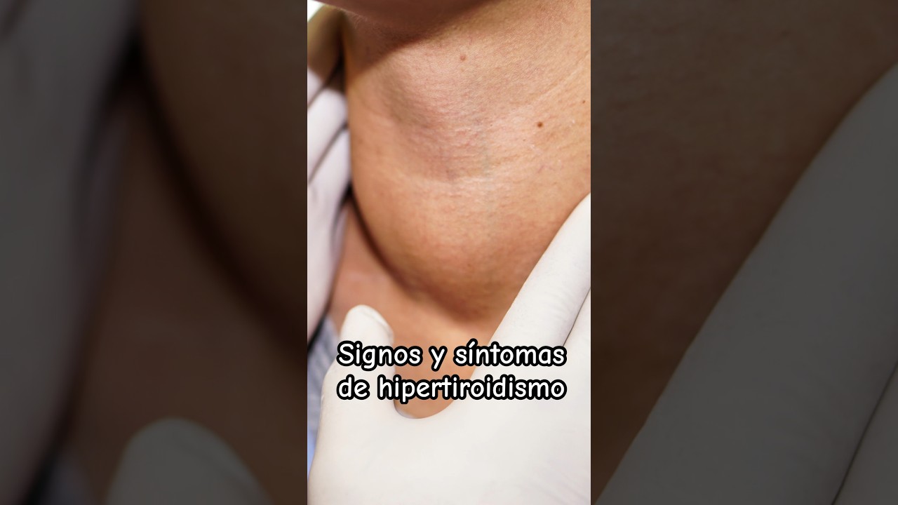 ¡Alerta! Hipertiroidismo, signos y síntomas | Dr. William Guerrero. #medicina #shorts