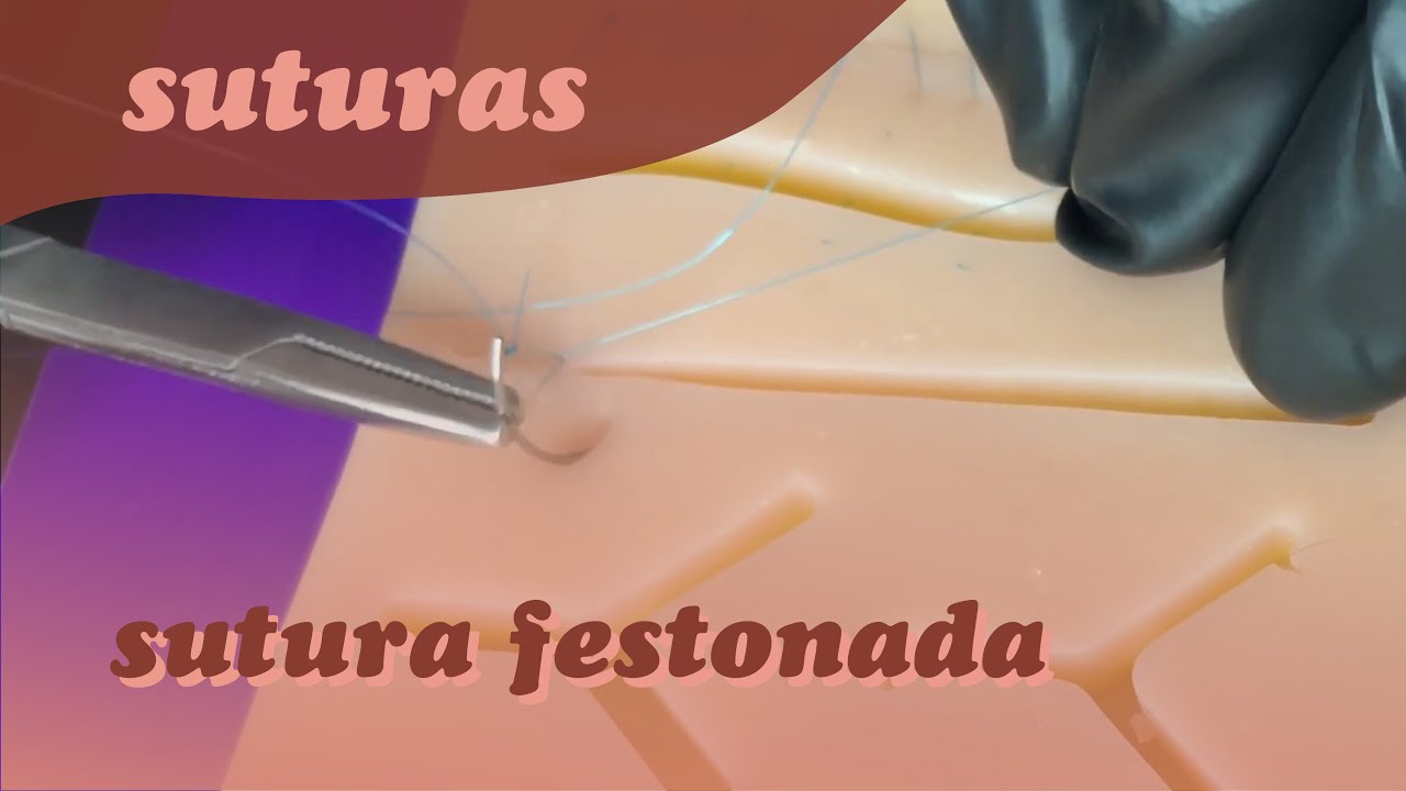 ‪Sutura Festonada, Retrógrada, Ancorada de Ford ou de Reverdin ‬