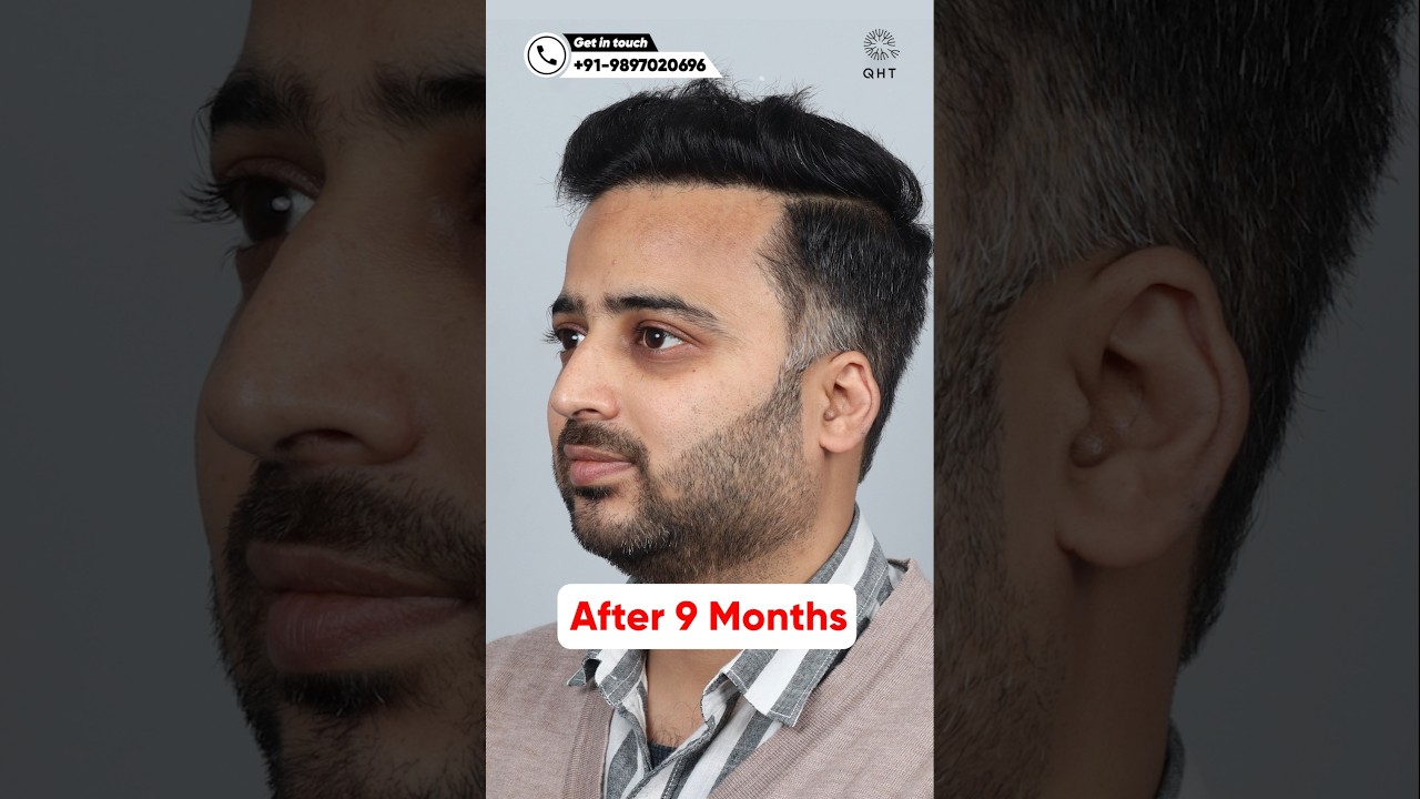 Nine Months Hair Transplant Results | Latest Fue Technique #shorts #viral #hair transplant