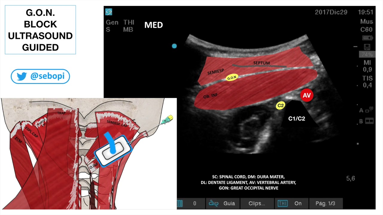 G.O.N. BLOCK ULTRASOUND GUIDED
