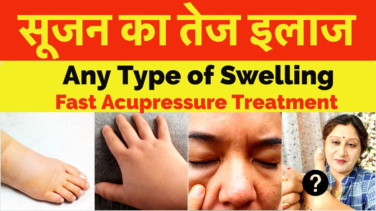 All Types Of Swelling Treatment By Acupressure Points || Sujok Therapy For Swelling || सूजन का इलाज