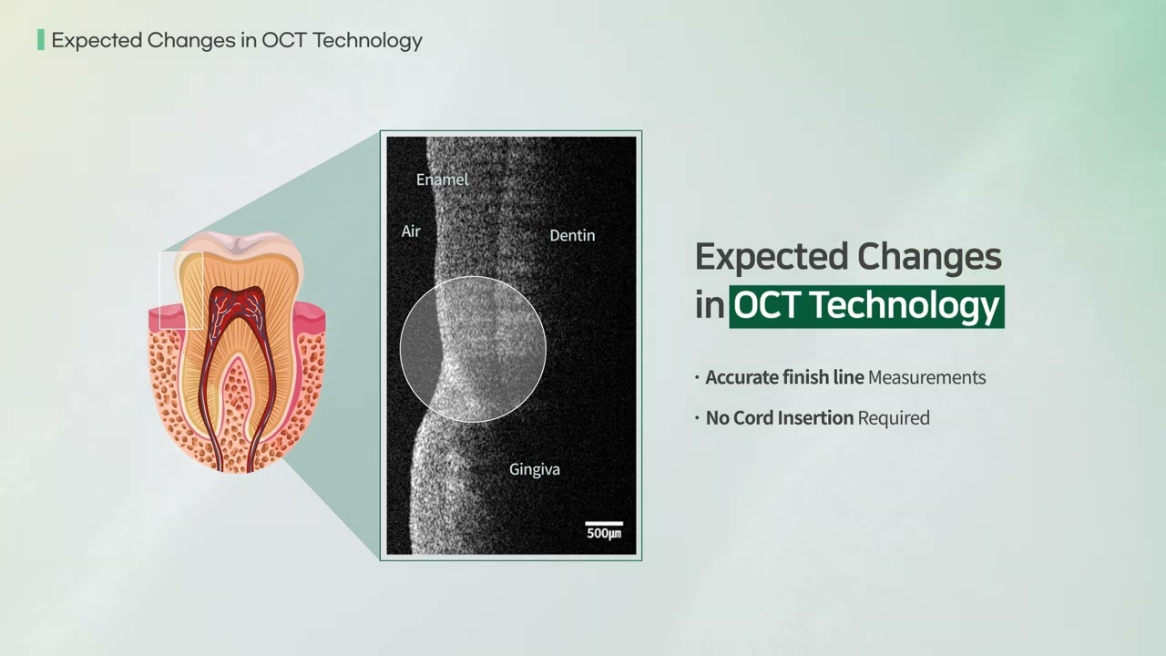 OCTiX : Intraoral OCT Scanner, Now Scan Inside and Out