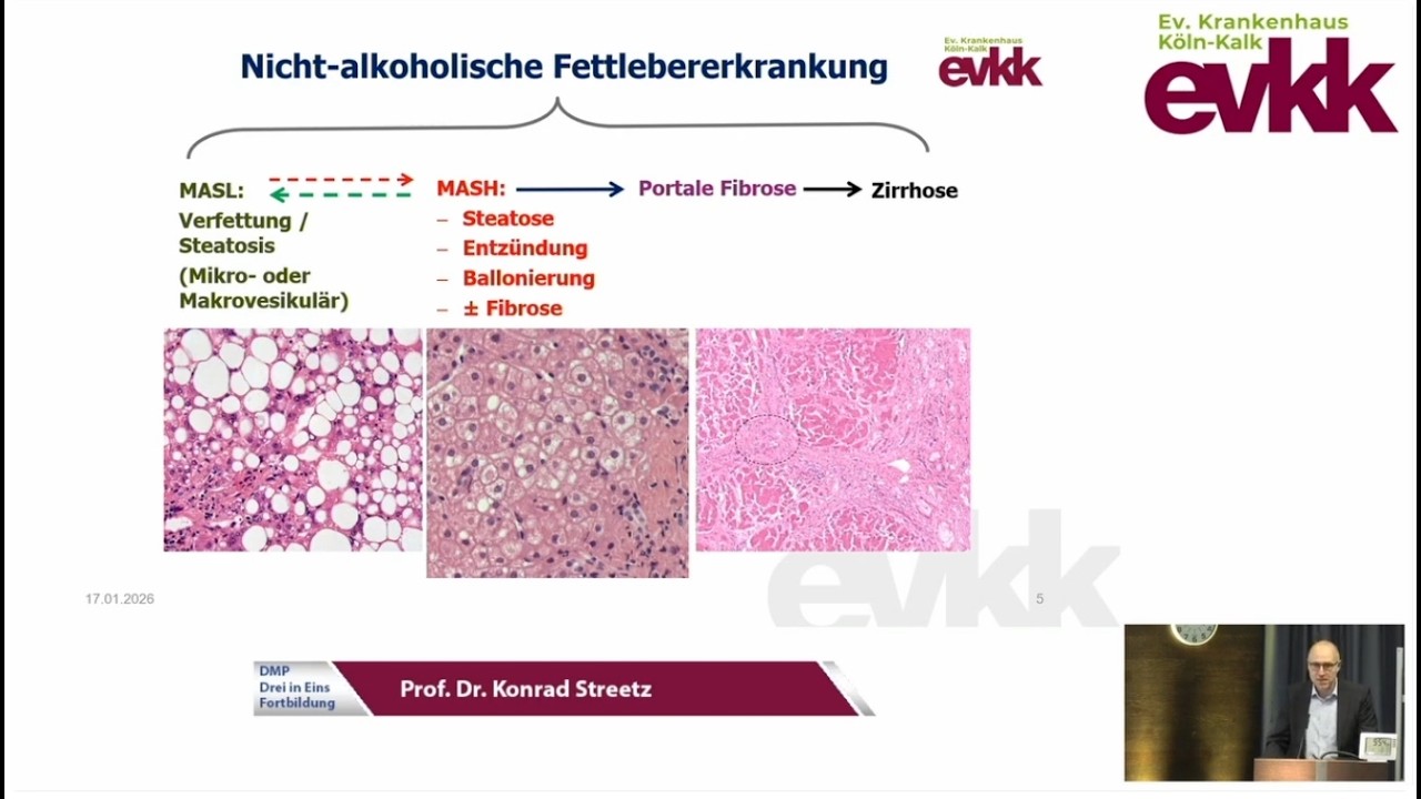 DMP Drei in Eins - Fortbildung 2026: MASLD - Was muss ich zu Leber und Diabetes wissen?