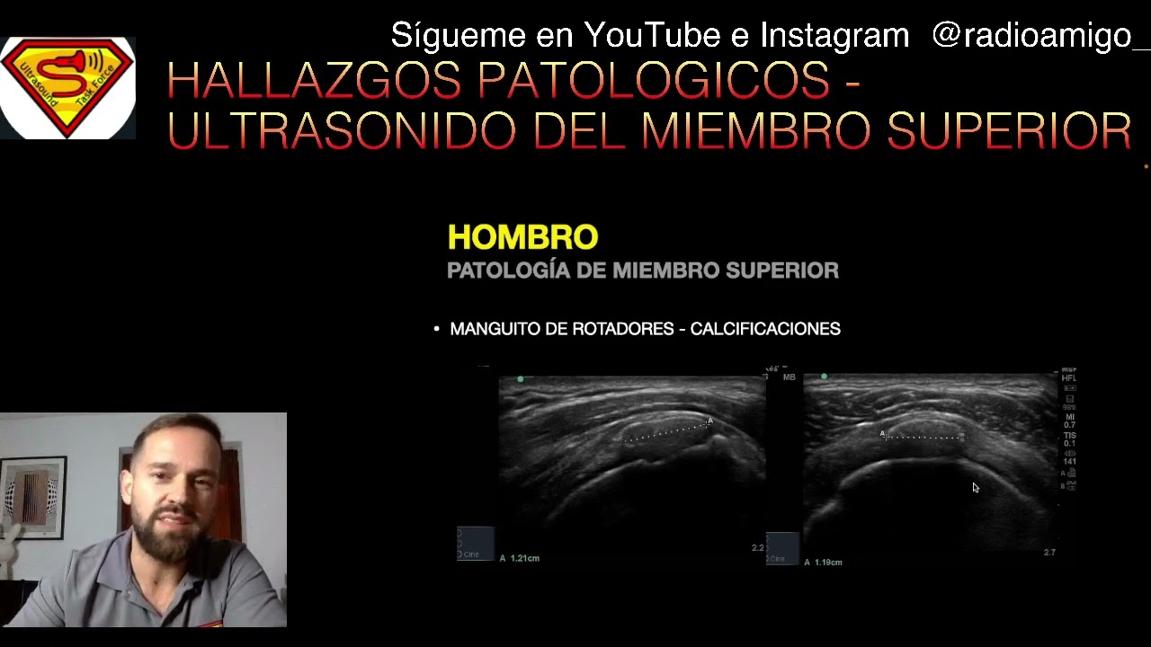 HALLAZGOS ECOGRAFICOS EN PATOLOGIA DEL MIEMBRO SUPERIOR
