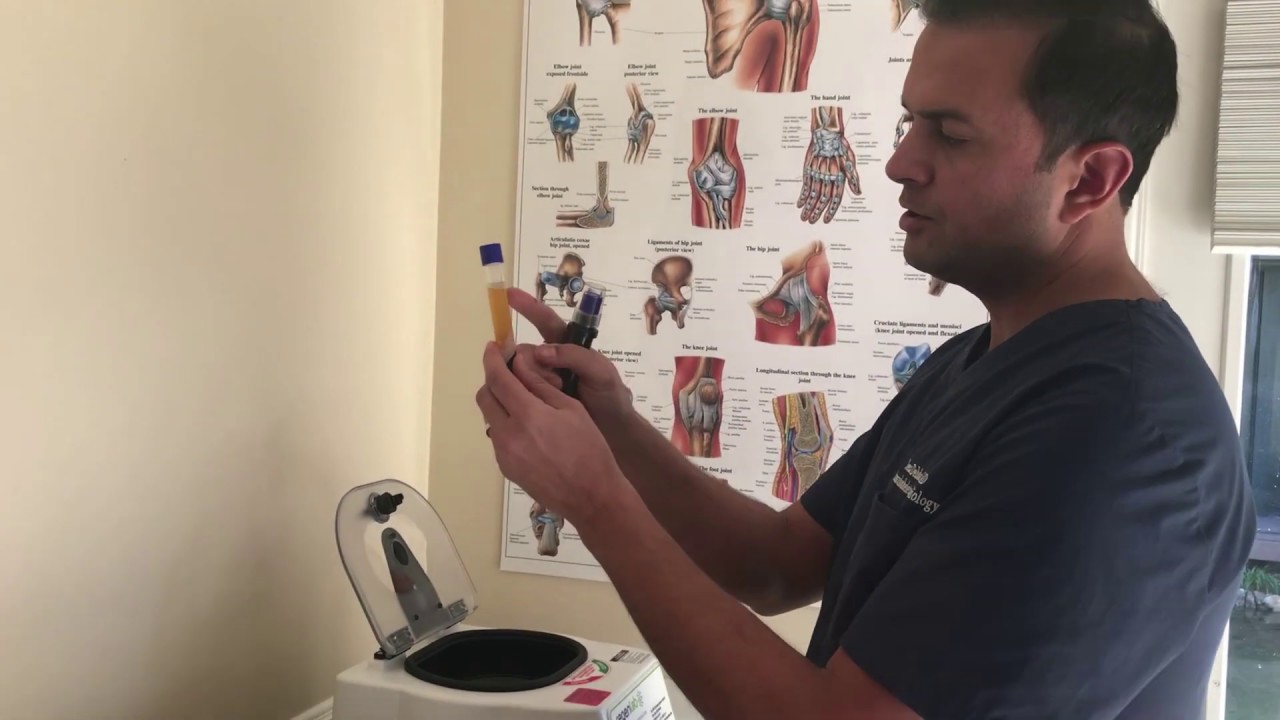 The Platelet Rich Plasma PRP Injection Process  Orange County CA