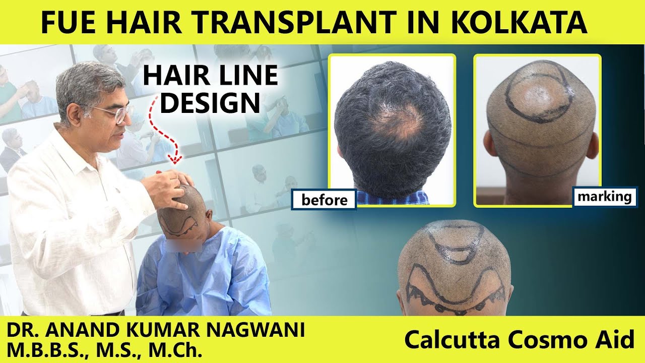 FUE Hair Transplant in Kolkata | Hairline Design by Dr Nagwani | Calcutta Cosmo aid