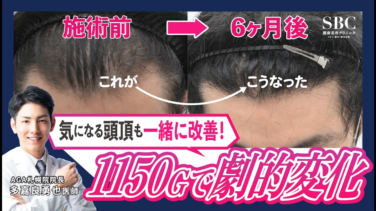 【30代男性の自毛植毛】自毛植毛×再生治療でM字部分と同時に頭頂部分も改善することができます！