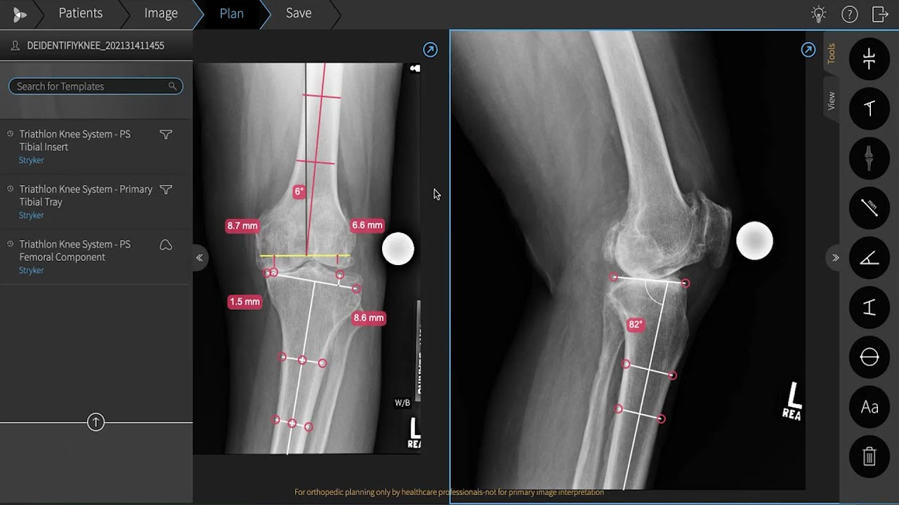 Planificación de Artroplastia de Rodilla con TraumaCad Mobile