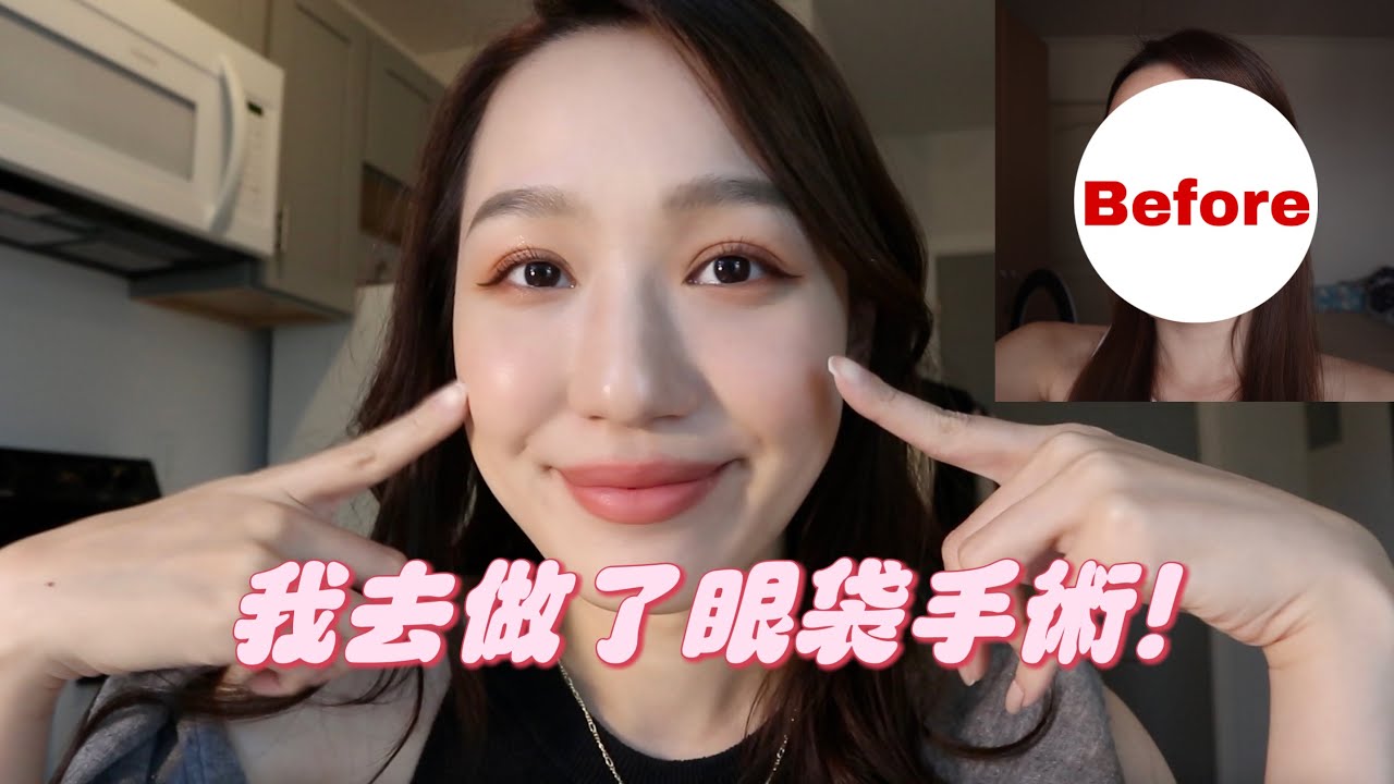 我去做眼袋手術了！人生中做過最正確的決定！？