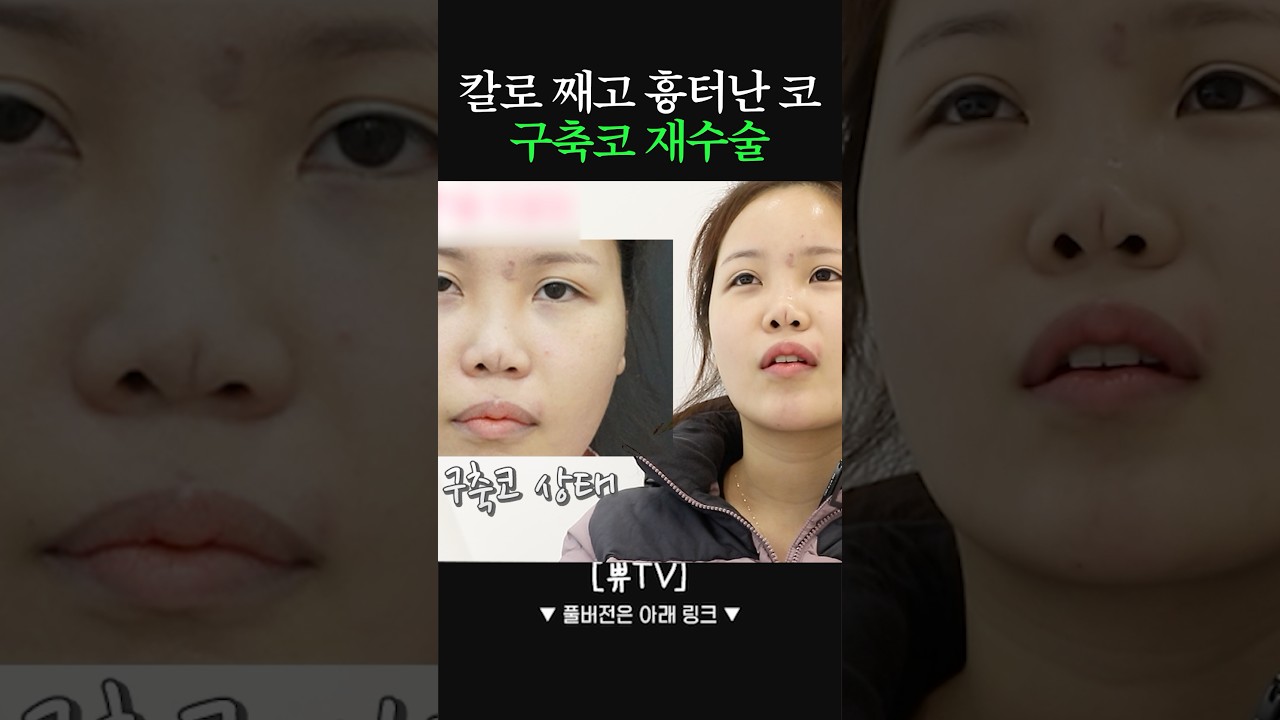 칼자국 난 코 재수술하기 