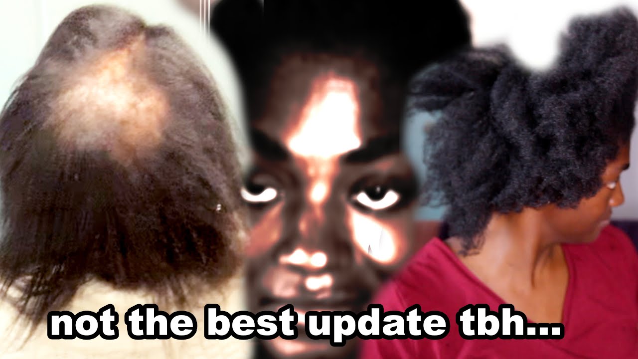 being REAL about my hair loss update. | Alopecia 4C Natural Hair