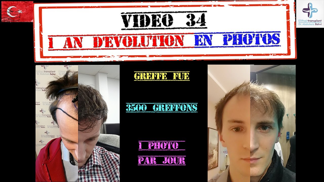 Evolution 1 an de Greffe de cheveux : Hairtransplant 1 year evolution