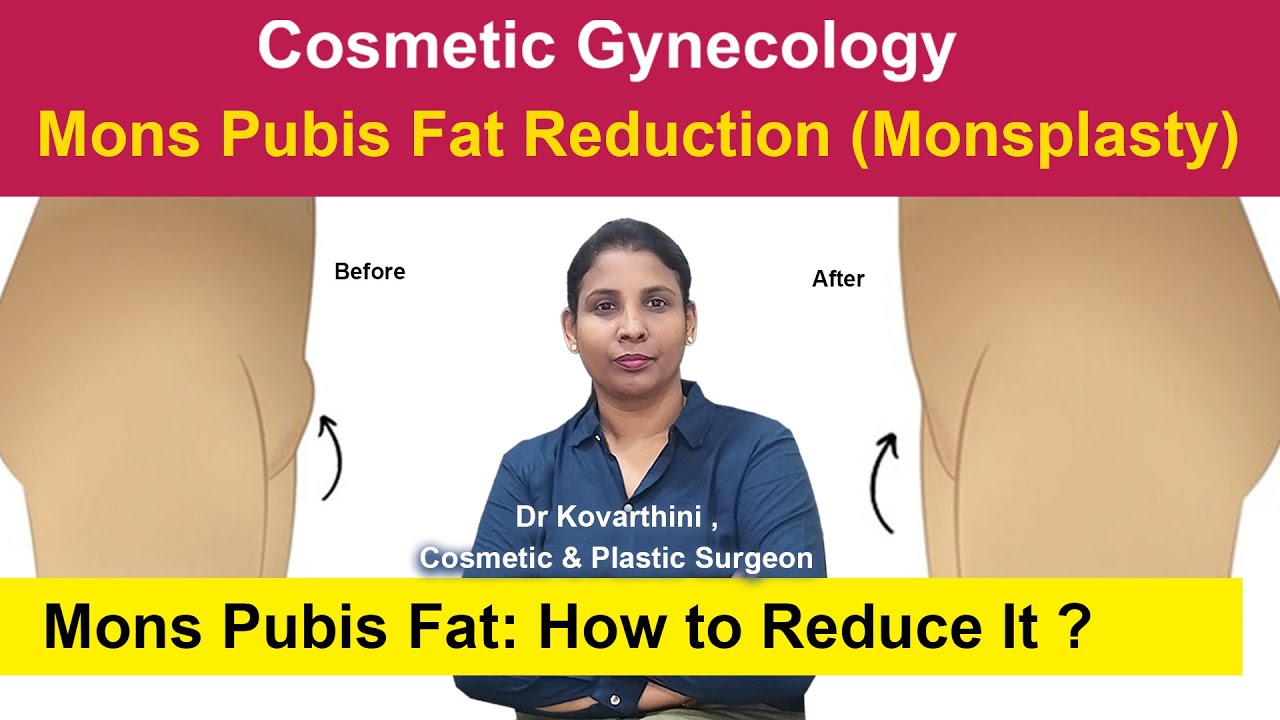 Cosmetic Gynecology ?Mons Pubis | Monsplasty Surgery | Dr. Kovarthini Cosmetic & Plastic Surgeon