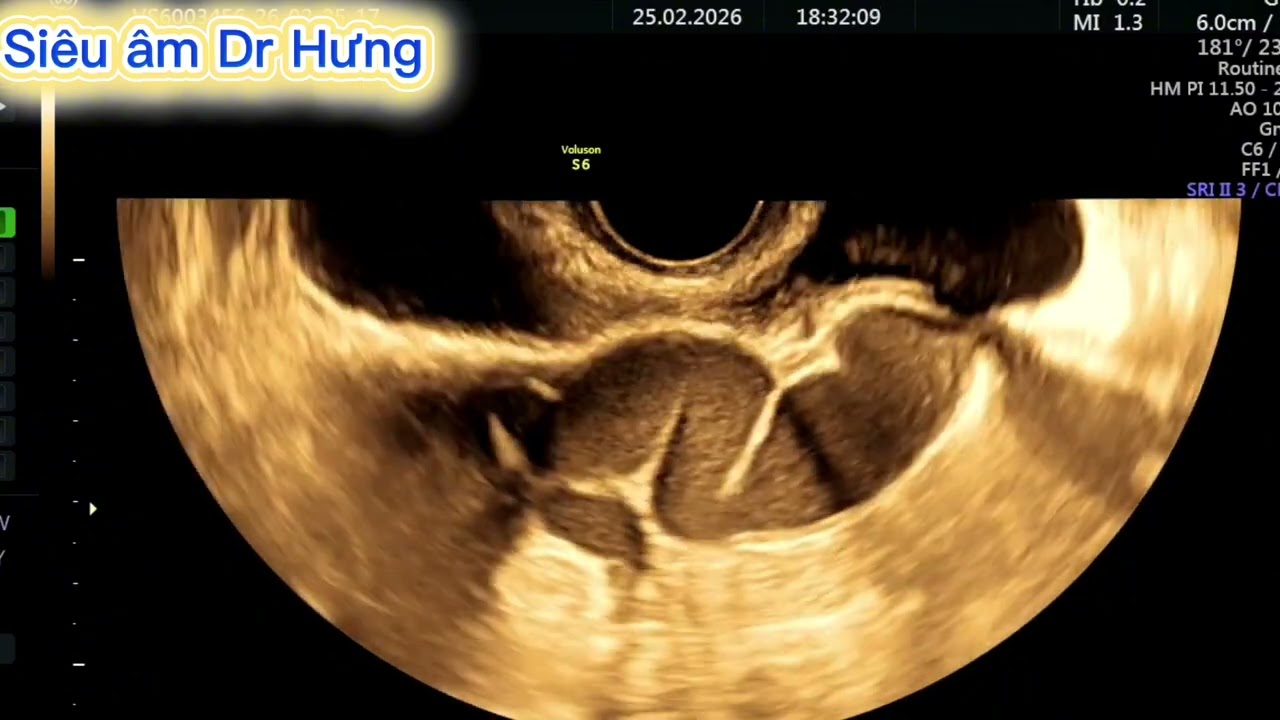 Ứ dịch vòi trứng DrHưng