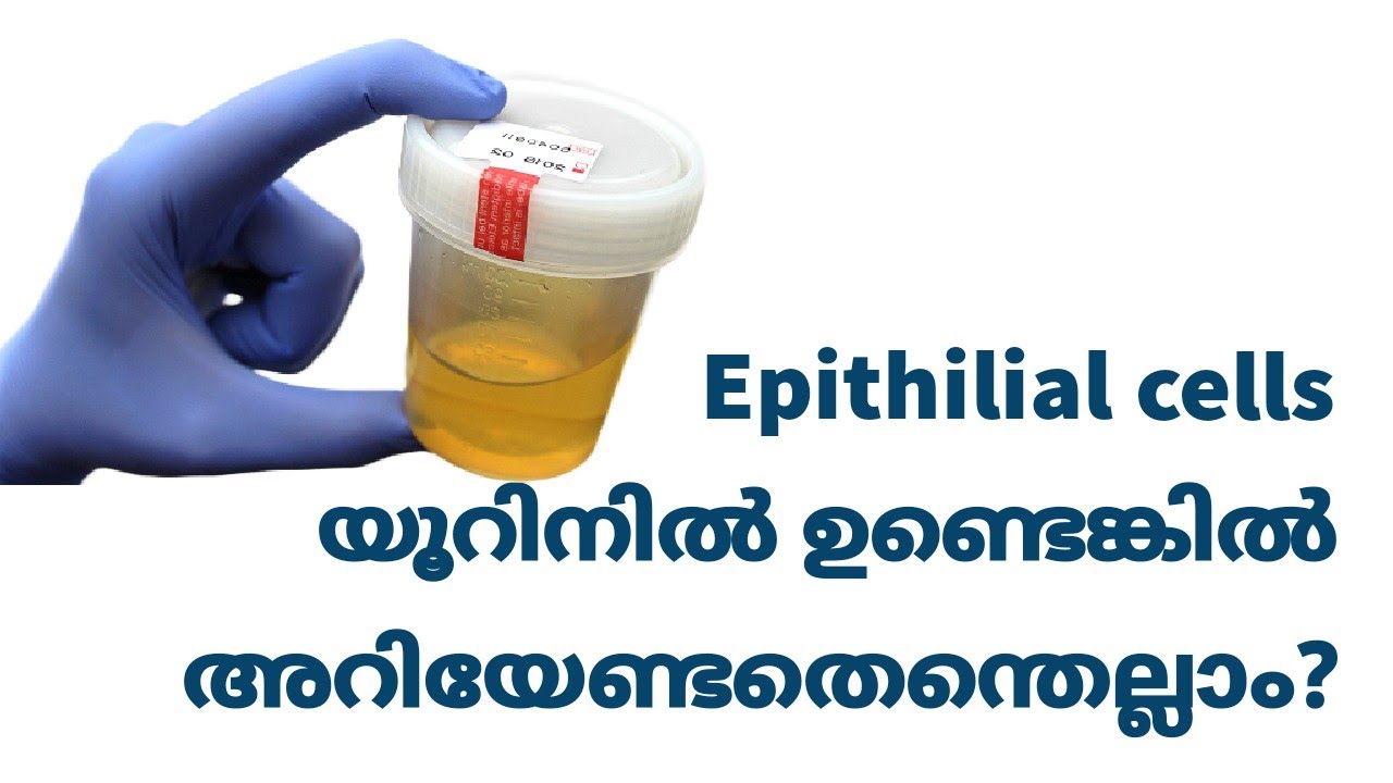 Epithelial Cells in Urine Malayalam