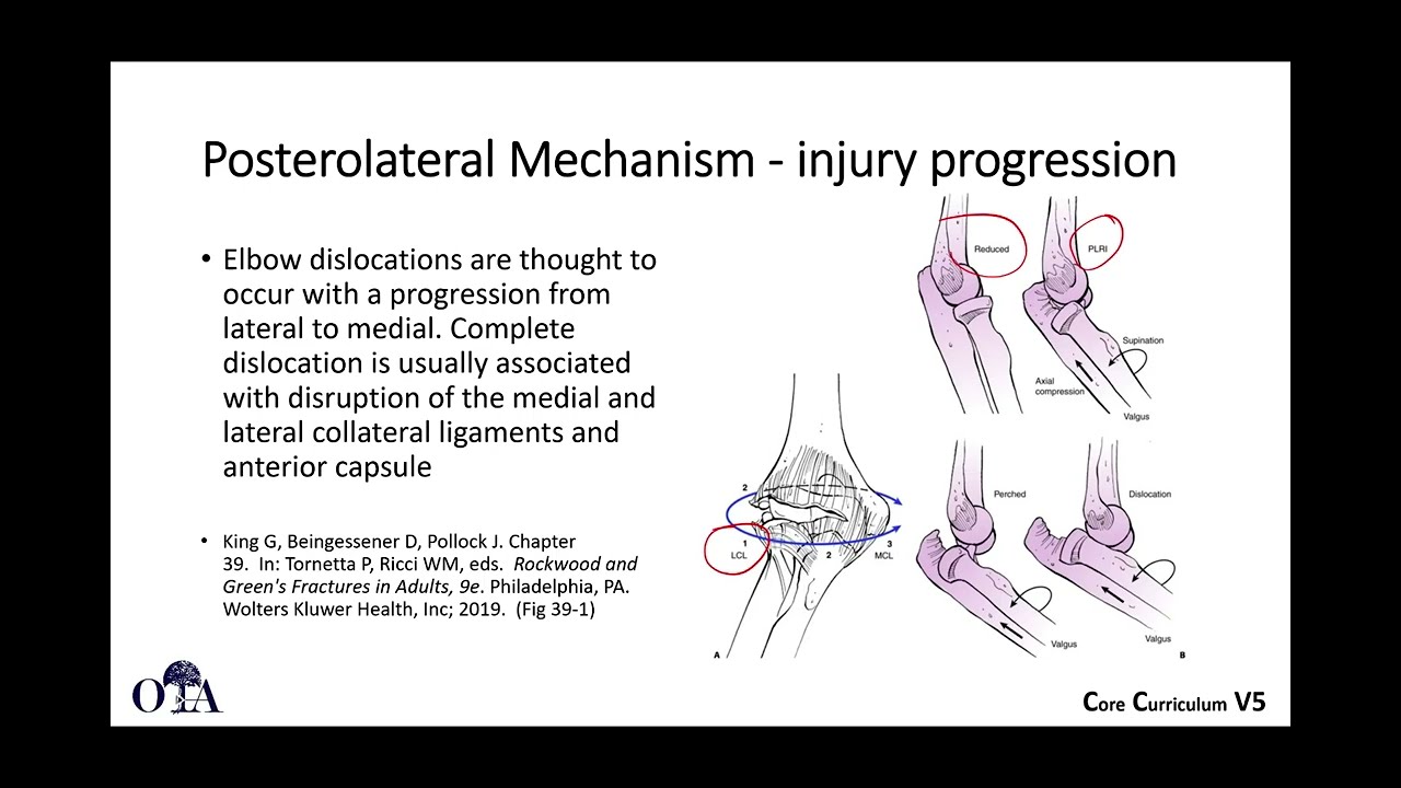 Traumatic elbow instability and terrible triad injuries - 1 of 3