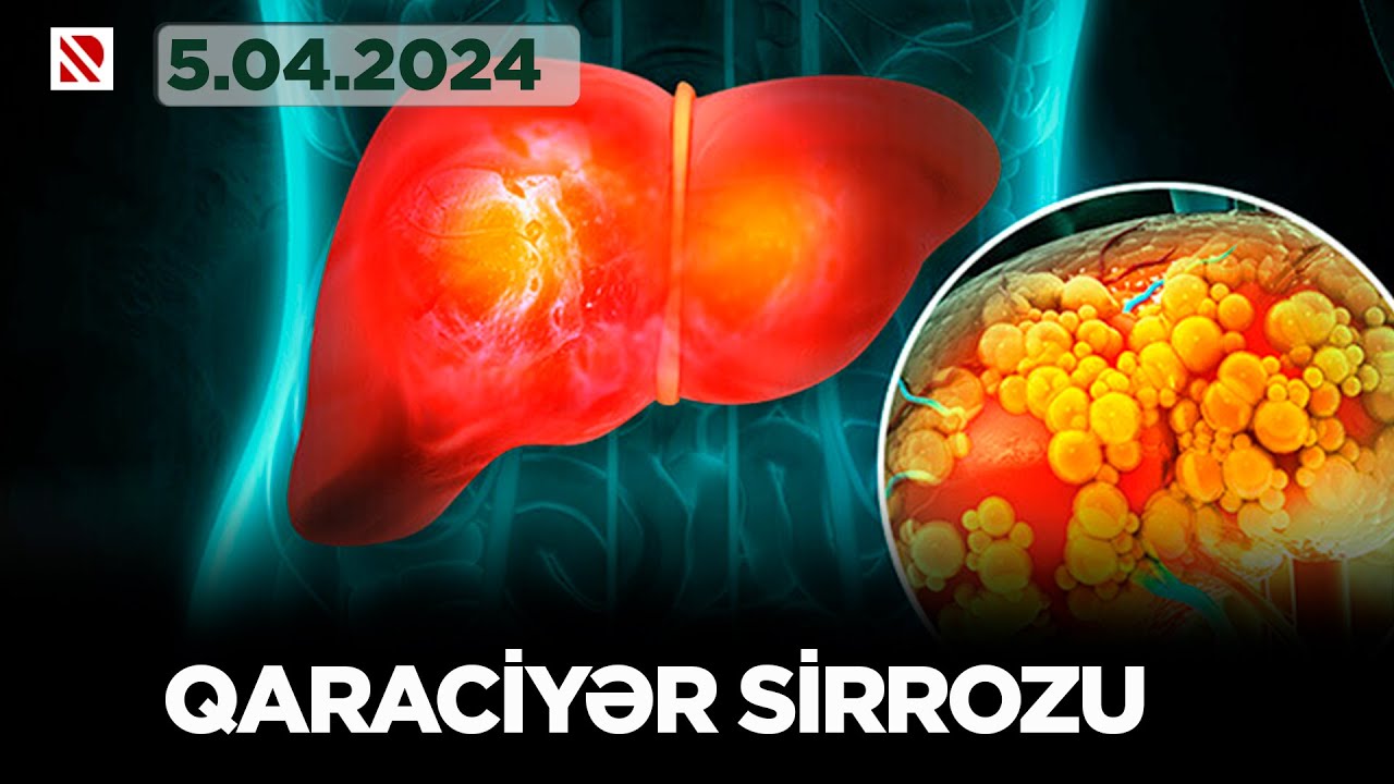 Can sağlığı: Qaraciyər sirrozu