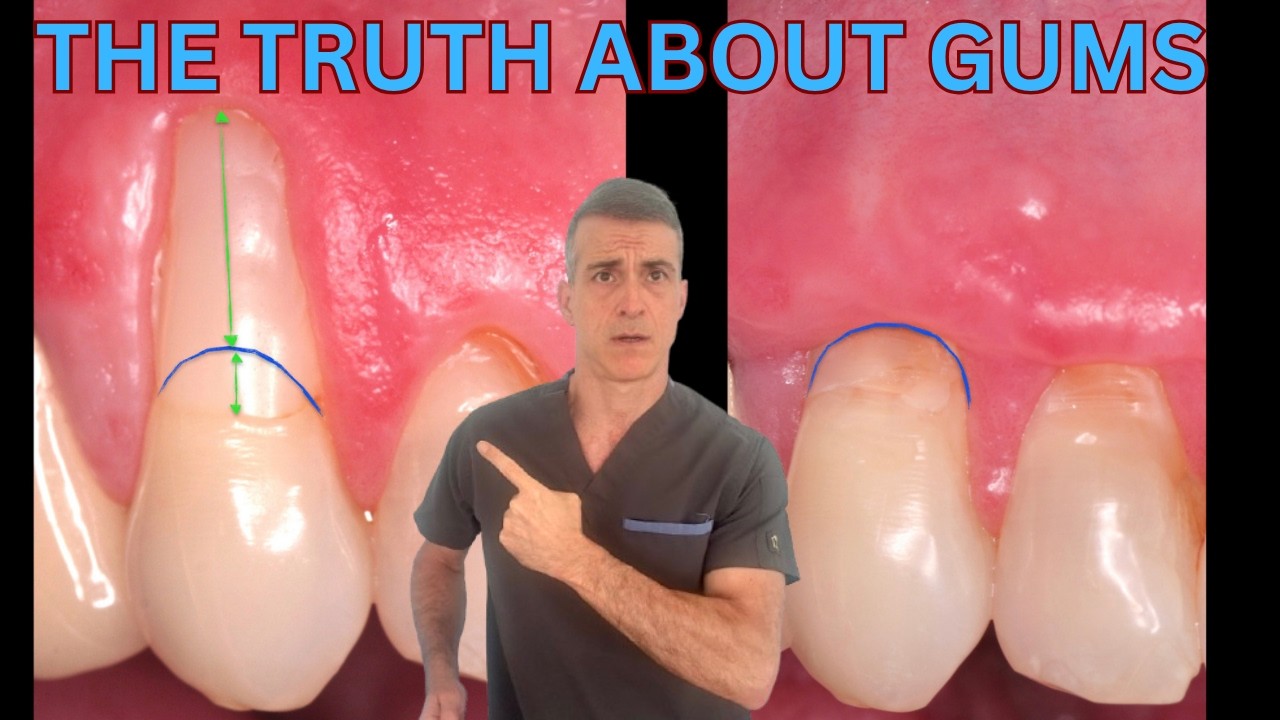 Why Fillings on Receding Gums Make Things Worse &mdash; and How to Actually Fix It | Periodontist