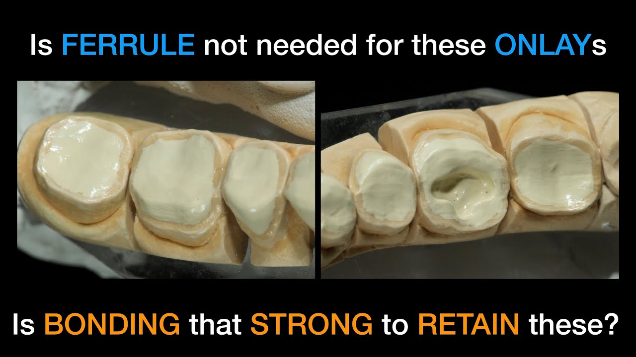 New Video- For those molar onlays does the concept of ferrule not come into play?