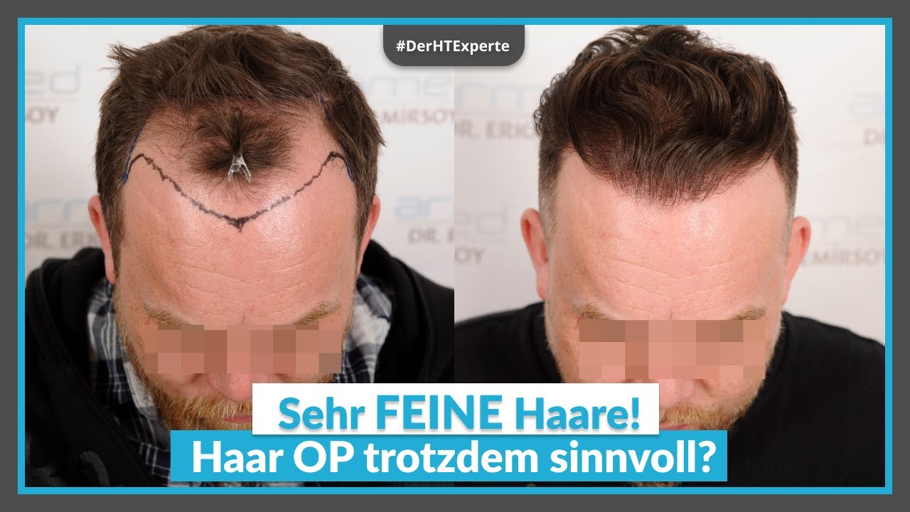 Haartransplantation trotz DÜNNER Haare? – Vorher Nachher Analyse