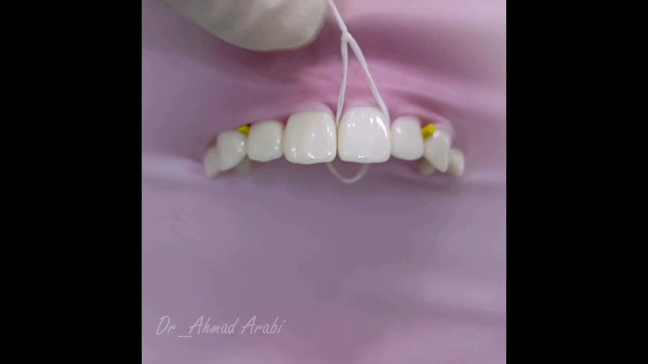 Dental Floss Ligature